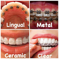 Brace Types